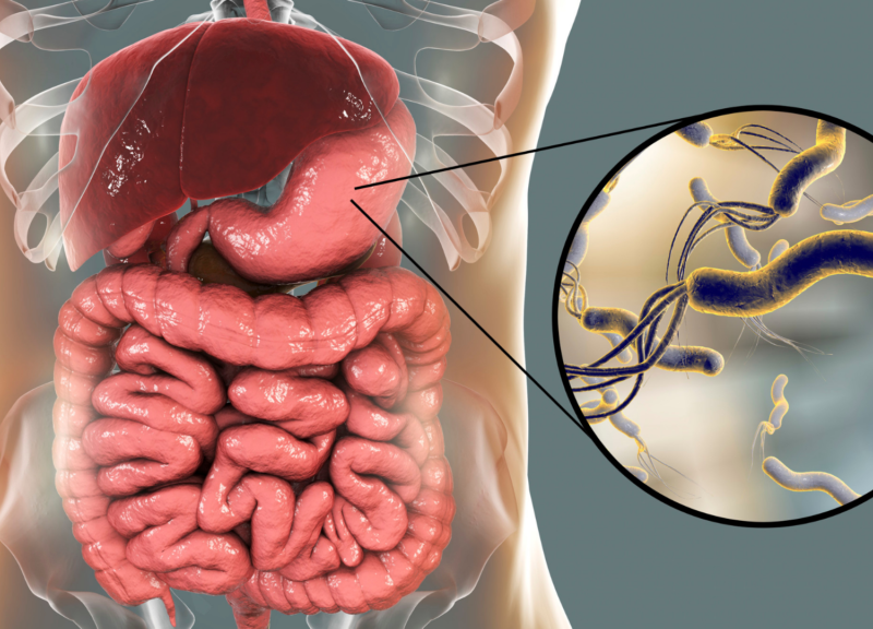 Zakażenie Helicobacter pylori – pułapki diagnostyczne i terapeutyczne w codziennej praktyce lekarza POZ